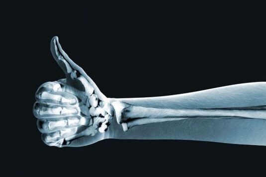 X-ray to diagnose pain in finger joints