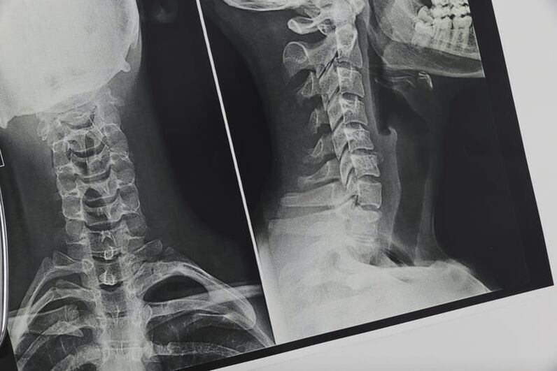 X-ray of cervical spine affected by osteonecrosis