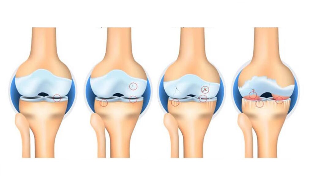 Osteoarthritis stage of the knee joint