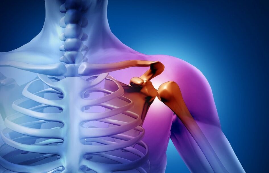 shoulder joint injury due to arthritis