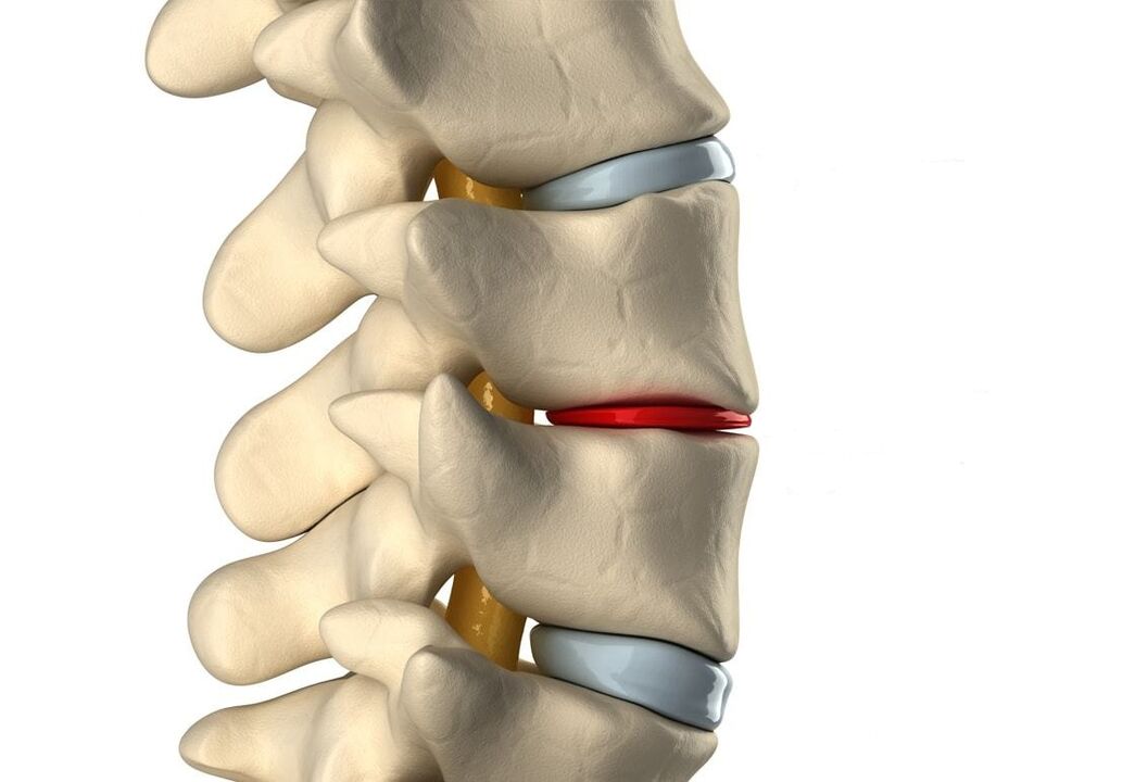 Healthy intervertebral disc (blue) and damaged by thoracic cartilage degeneration (red)