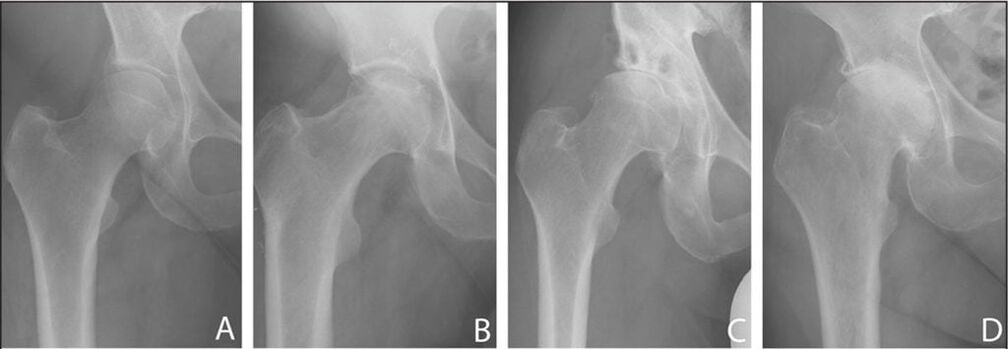 Stages of development of hip osteoarthritis on X-ray