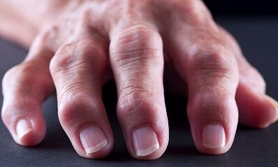 What is the difference between arthritis because of arthritis
