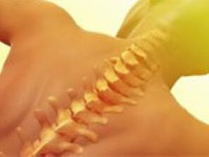 Osteochondrosis - Spine