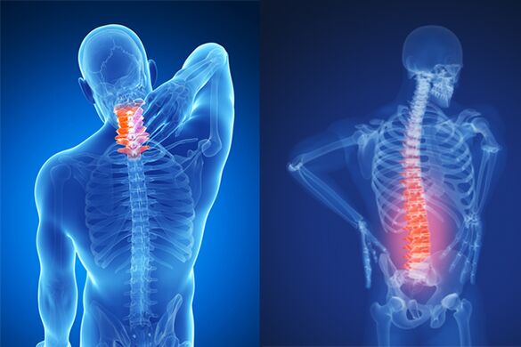 Osteoarthritis of the cervical and lumbar spine