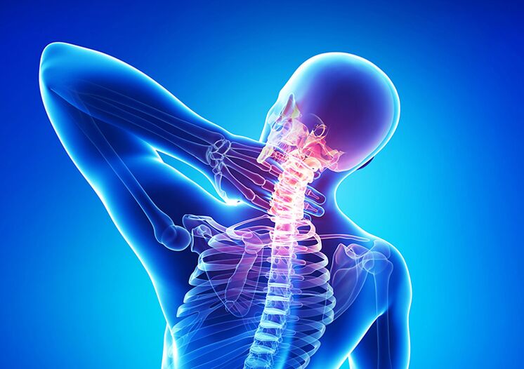 Spondylosis is a disease that affects joint cartilage and vertebrae.
