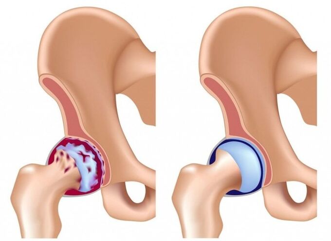 Hip joint damage due to arthritis