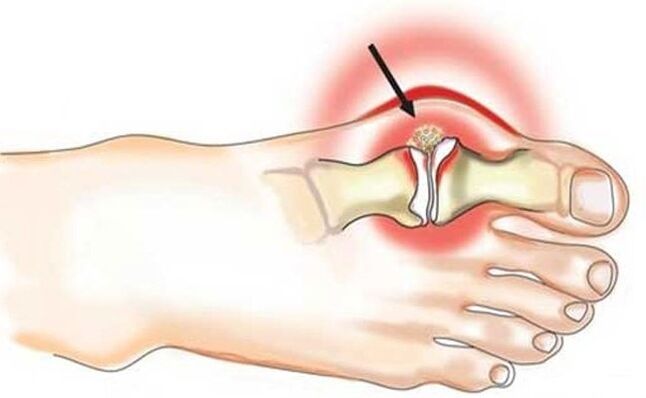 Joint inflammation between the big toe and foot due to arthritis
