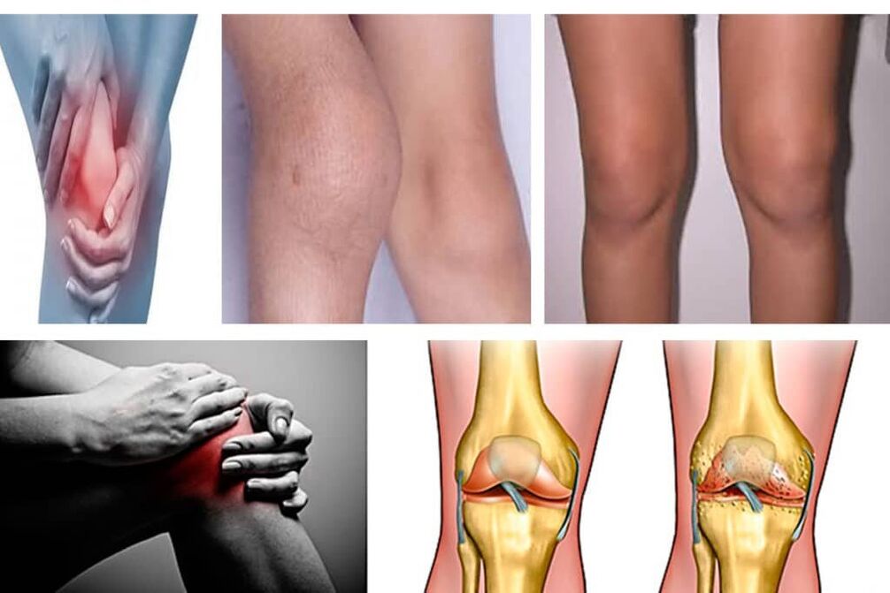 What is arthritis