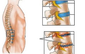 Causes of osteoarthritis of the waist