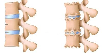 How to realize the presence of osteoarthritis of the waist