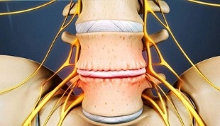 The main symptoms of cervical bone necrosis